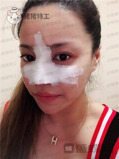 成都格莱丽王伟鼻部手术案例价格分享,做了鼻子的小姐姐混血感十足~