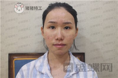 陕西韩媚王仁根面部填充案例价格分享,年轻了不止十岁感受一下~