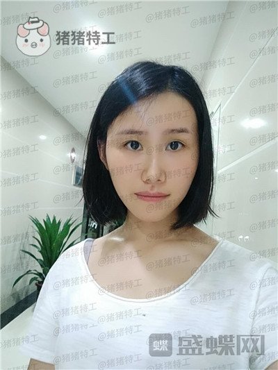 陕西韩媚王仁根面部填充案例价格分享,年轻了不止十岁感受一下~