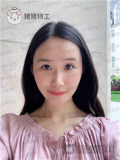 陕西韩媚王仁根面部填充案例价格分享,年轻了不止十岁感受一下~
