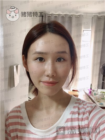 陕西韩媚王仁根面部填充案例价格分享,年轻了不止十岁感受一下~