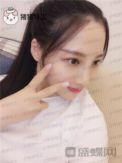 四川友谊张立天颧骨整形案例价格分享,阿姨变小仙女蜕变的很惊艳~