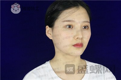 四川友谊张立天颧骨整形案例价格分享,阿姨变小仙女蜕变的很惊艳~