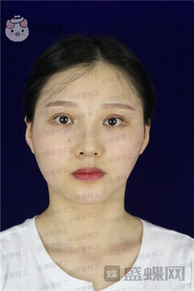 四川友谊张立天颧骨整形案例价格分享,阿姨变小仙女蜕变的很惊艳~