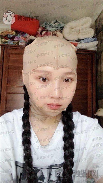 四川友谊张立天颧骨整形案例价格分享,阿姨变小仙女蜕变的很惊艳~