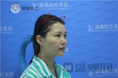 长沙凯莱肖立卫面部吸脂案例价格分享,脸不只是笑了一丁半点!