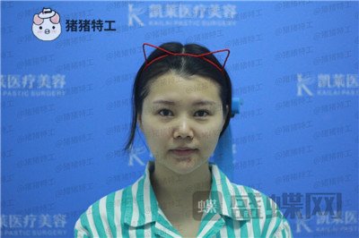 长沙凯莱肖立卫面部吸脂案例价格分享,脸不只是笑了一丁半点!