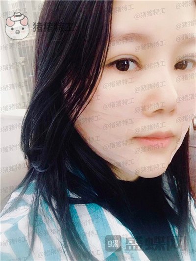 长沙凯莱肖立卫面部吸脂案例价格分享,脸不只是笑了一丁半点!