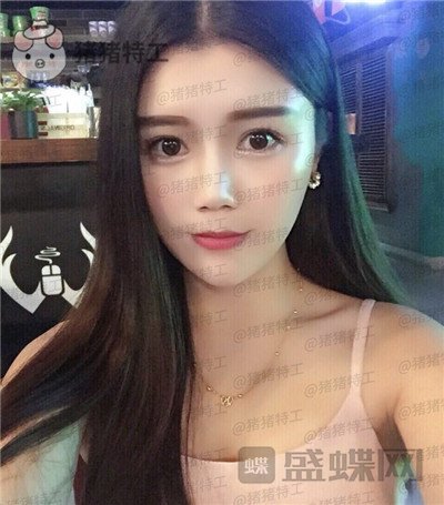 长沙凯莱肖立卫面部吸脂案例价格分享,脸不只是笑了一丁半点!
