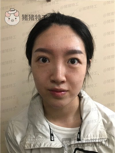 上海愉悦美联臣陈红梅面部填充案例价格分享,年轻的感觉真的很快乐~