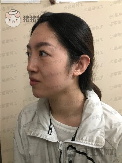 上海愉悦美联臣陈红梅面部填充案例价格分享,年轻的感觉真的很快乐~