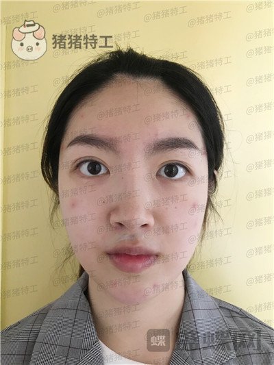 上海愉悦美联臣陈红梅面部填充案例价格分享,年轻的感觉真的很快乐~