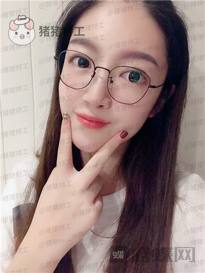 上海愉悦美联臣陈红梅面部填充案例价格分享,年轻的感觉真的很快乐~