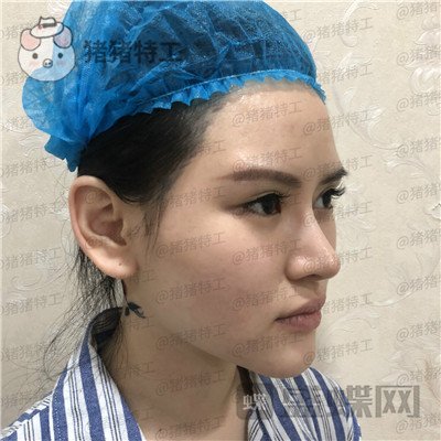深圳美芮王权面部填充案例价格分享,动过全脸就差一个面填综合全部。