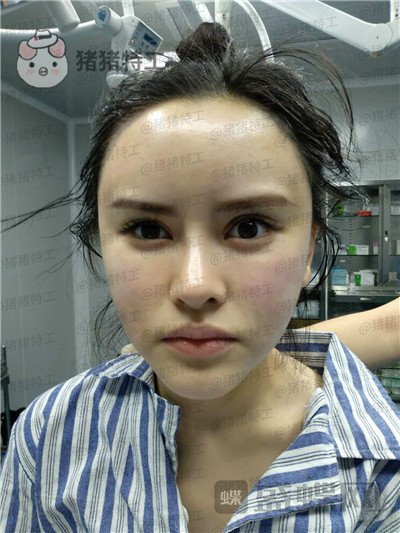 深圳美芮王权面部填充案例价格分享,动过全脸就差一个面填综合全部。