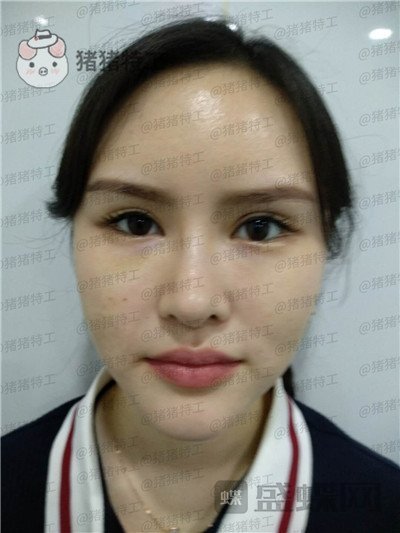 深圳美芮王权面部填充案例价格分享,动过全脸就差一个面填综合全部。