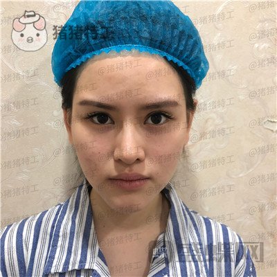 深圳美芮王权面部填充案例价格分享,动过全脸就差一个面填综合全部。