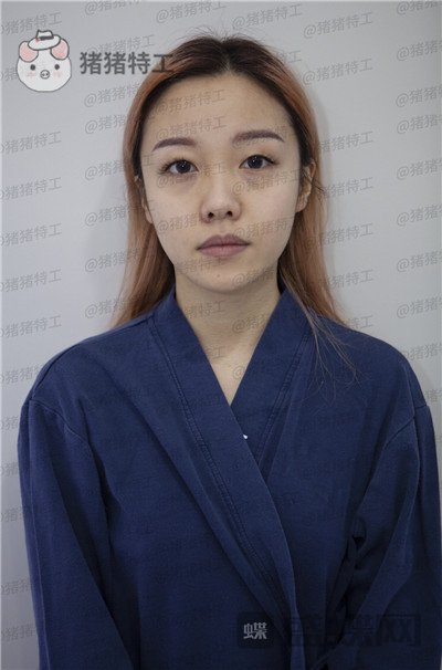 重庆铂生郝荣涛双眼皮案例价格分享,本身就是小仙女做完自带光环~