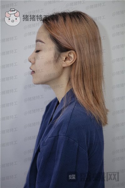 重庆铂生郝荣涛双眼皮案例价格分享,本身就是小仙女做完自带光环~