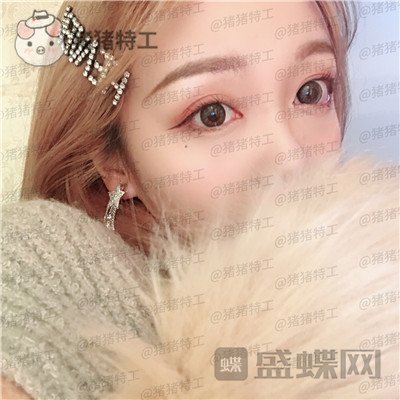 重庆铂生郝荣涛双眼皮案例价格分享,本身就是小仙女做完自带光环~