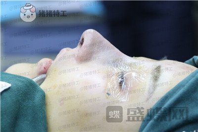 北京长虹于志宏隆鼻案例价格分享,我就是喜欢混血网红风没什么毛病