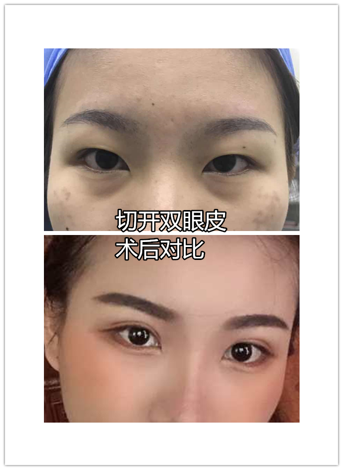 清卧蚕和眼袋有什么不同?