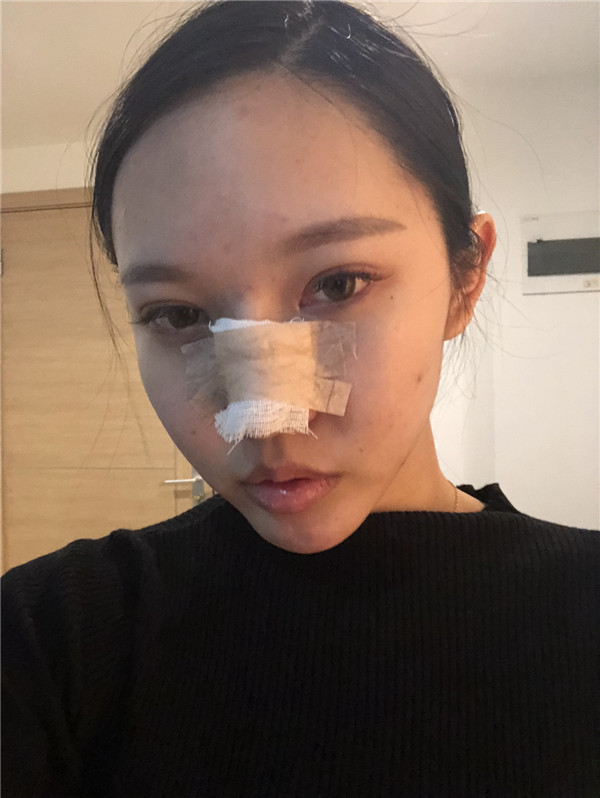 成都纽莱茵孙熙东鼻部手术怎么样?案例