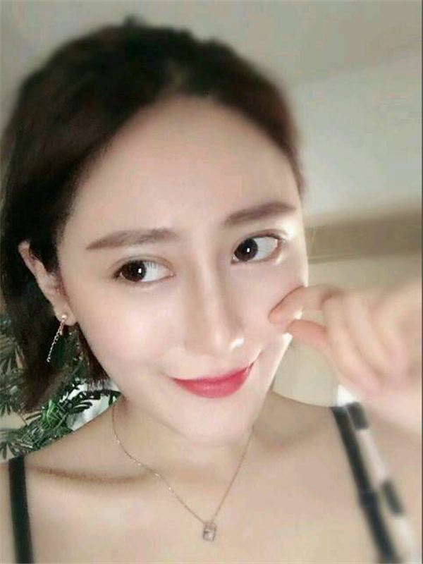 无锡施尔美吕韩伟做眼睛怎么样?案例