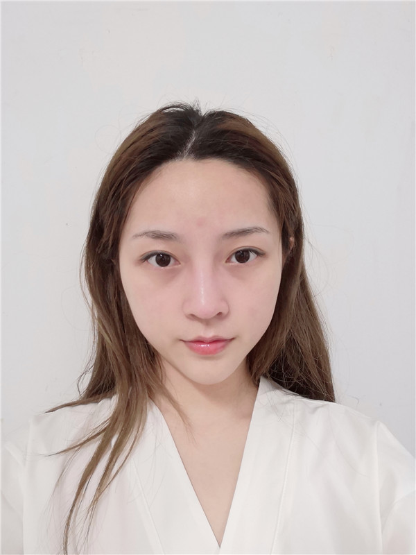 武汉艺星杨斐隆鼻怎么样?案例