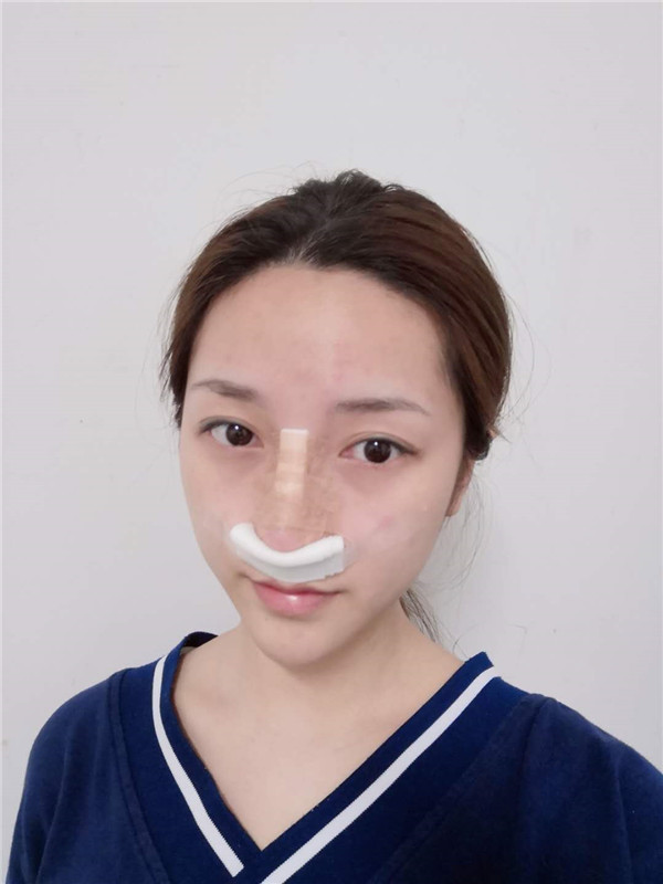 武汉艺星杨斐隆鼻怎么样?案例