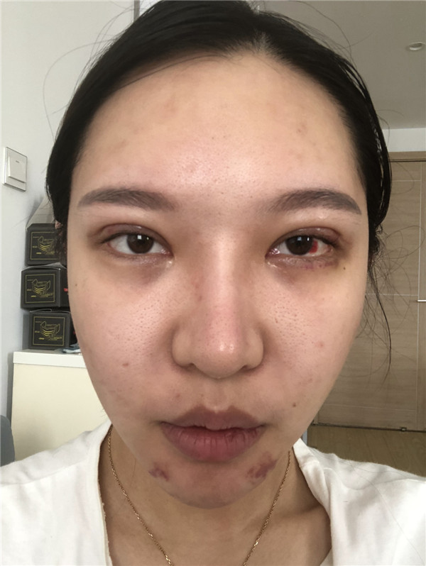 成都纽莱茵孙熙东脂肪填充怎么样,隆鼻价格案