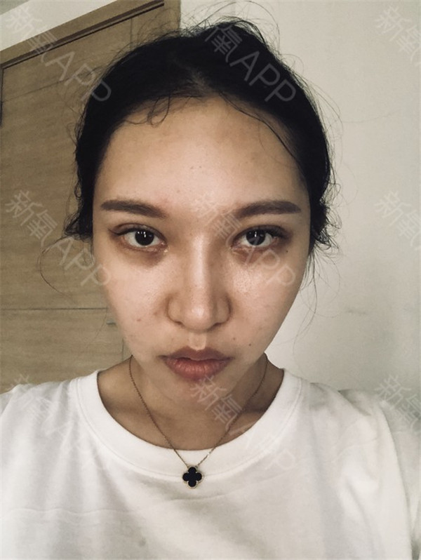 成都纽莱茵孙熙东脂肪填充怎么样,隆鼻价格案