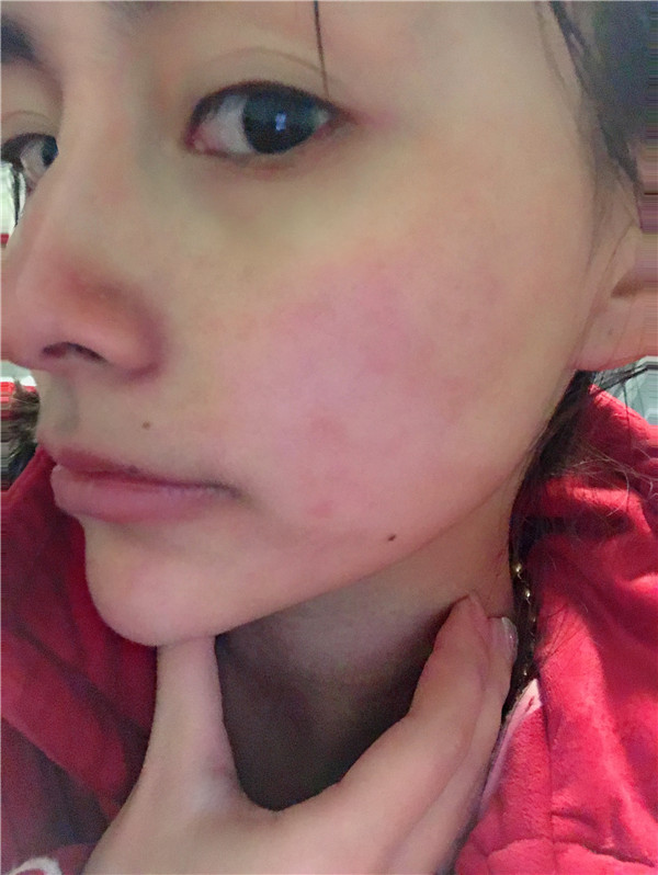 广东画美谢少玲镭射净肤怎么样?价格案例