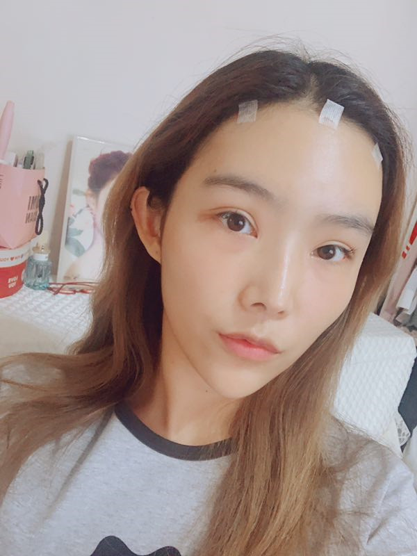 上海翡立思唐为东脂肪填充怎么样?价格案例