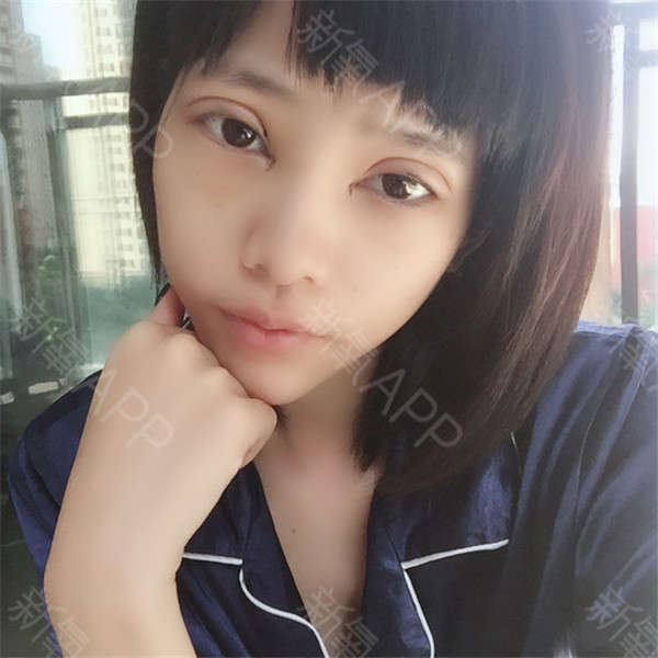 武汉希思特郑攻科双眼皮怎么样?价格案例