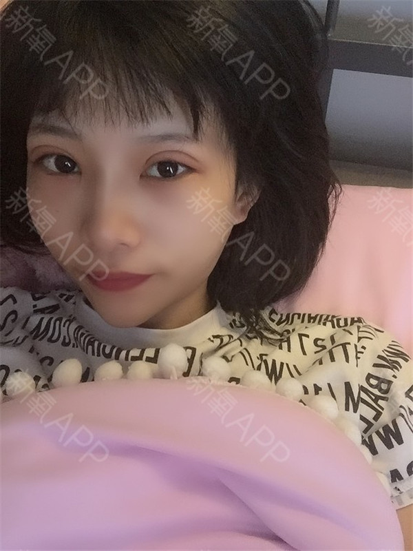 武汉希思特郑攻科双眼皮怎么样?价格案例