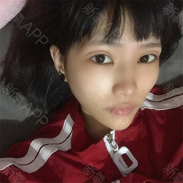 武汉希思特郑攻科双眼皮怎么样?价格案例