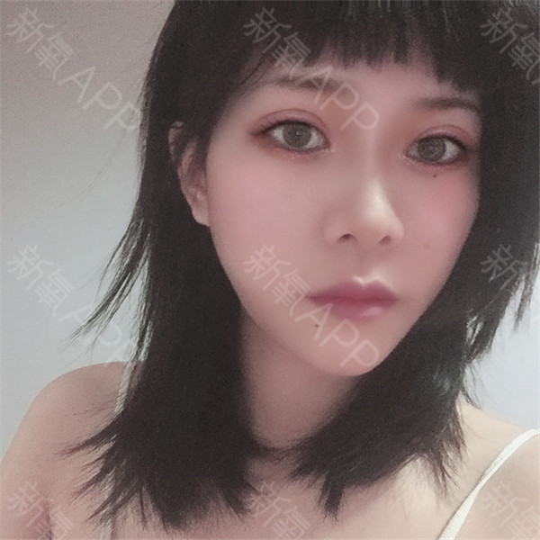 武汉希思特郑攻科双眼皮怎么样?价格案例
