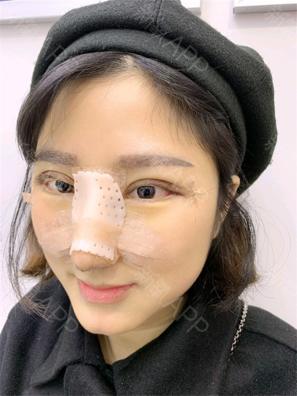 重庆铂生杜亚旭隆鼻双眼皮怎么样?价格案例
