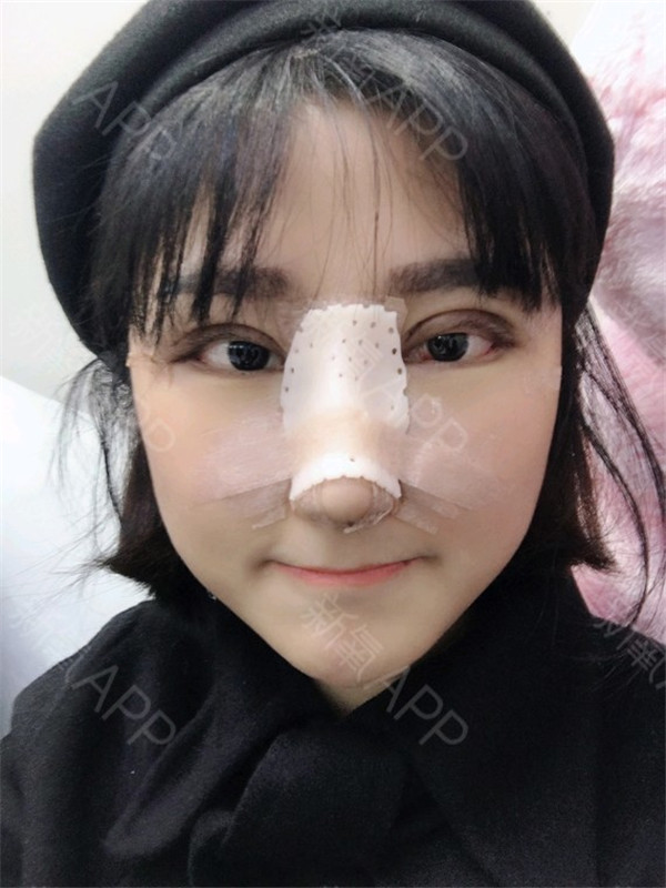 重庆铂生杜亚旭隆鼻双眼皮怎么样?价格案例