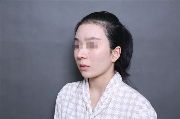 北京圣嘉荣黄大勇下颌角磨骨怎么样,价格案例