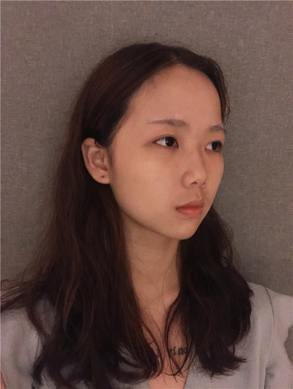 台州博雅美惠王大明脂肪填充怎么样?价格案例