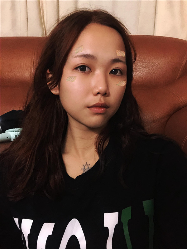 台州博雅美惠王大明脂肪填充怎么样?价格案例