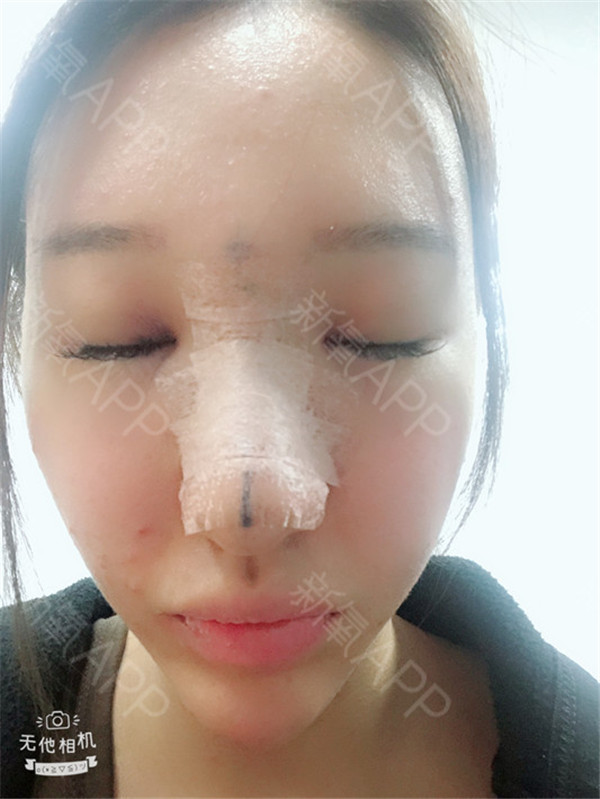 福州美贝尔赵栋材软骨隆鼻怎么样?价格案例