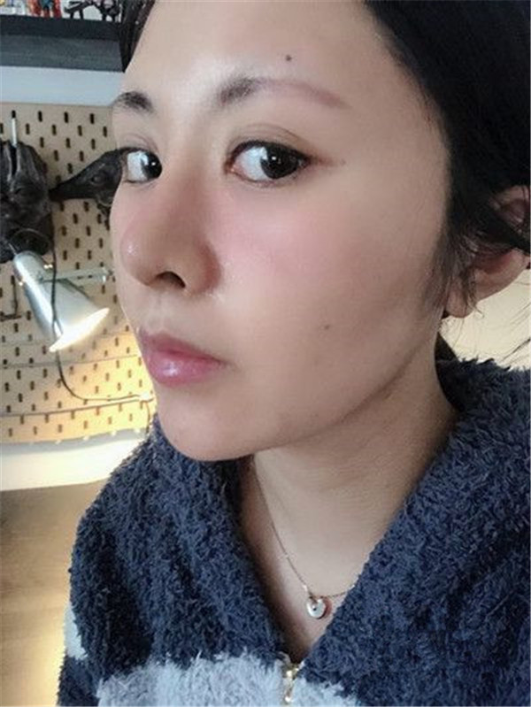 遵义韩美于建涛硅胶隆鼻怎么样?价格案例