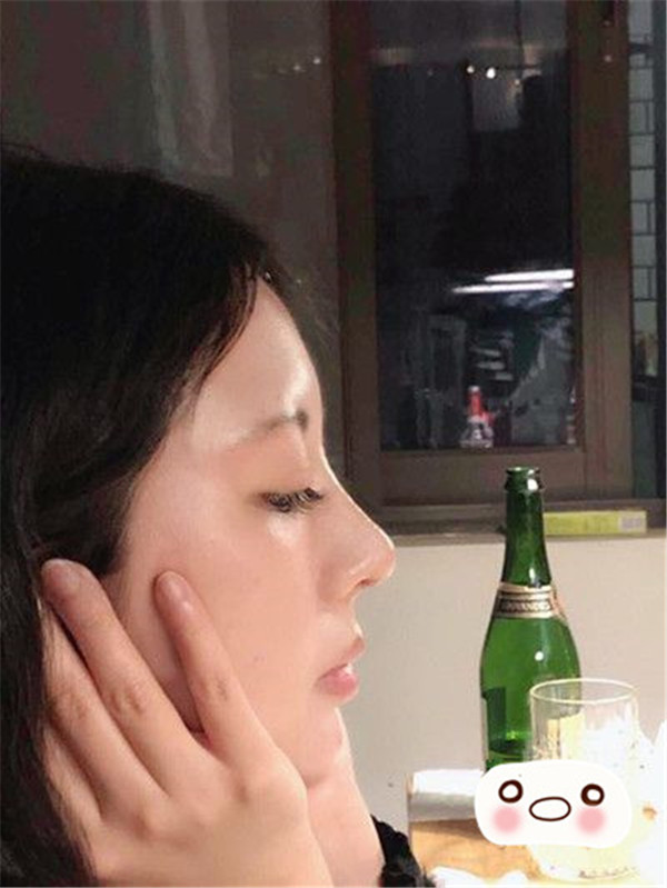 遵义韩美于建涛硅胶隆鼻怎么样?价格案例