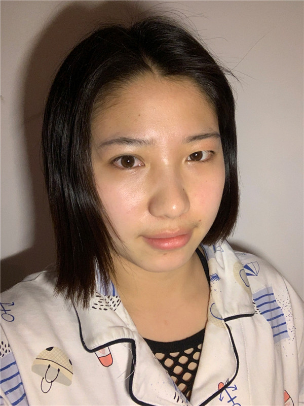 哈尔滨成美常城割双眼皮怎么样?价格案例