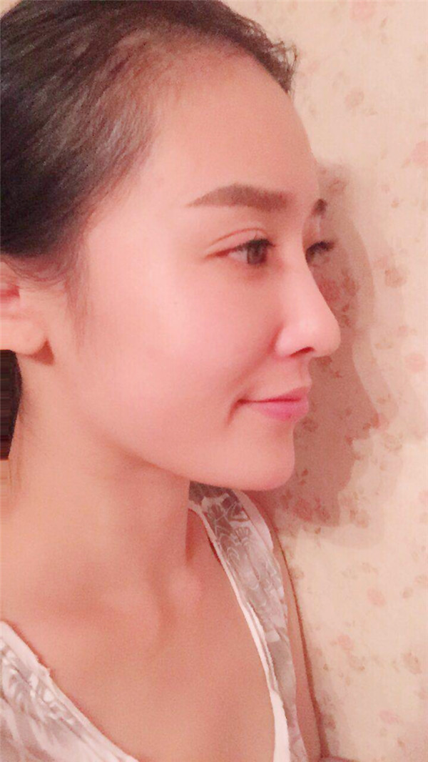 武汉美立方软骨隆鼻怎么样?价格案例