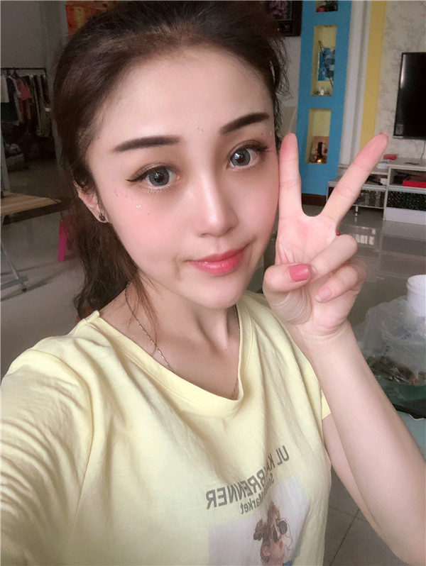 兰州亚韩李军梅软骨隆鼻怎么样?价格案例