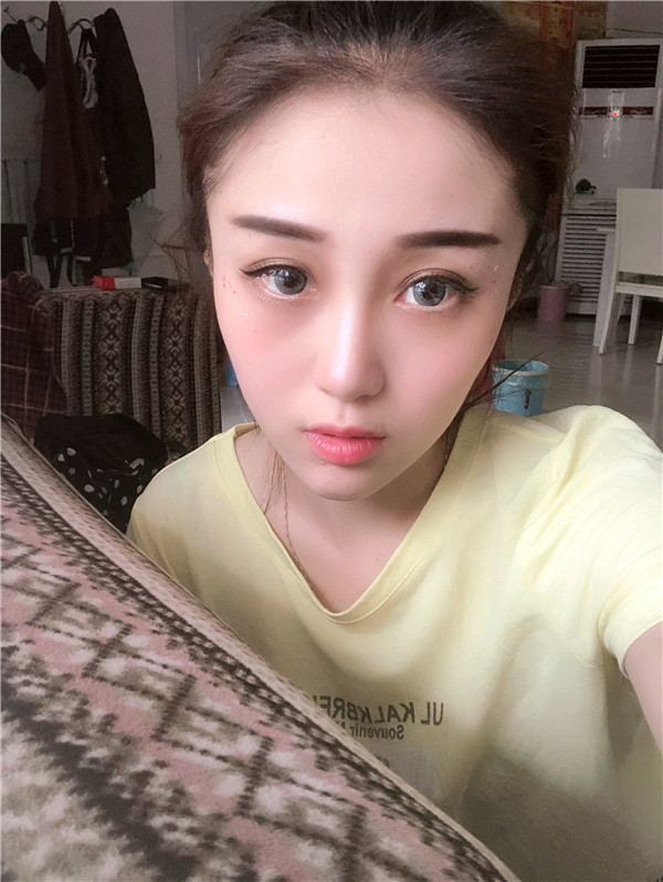 兰州亚韩李军梅软骨隆鼻怎么样?价格案例
